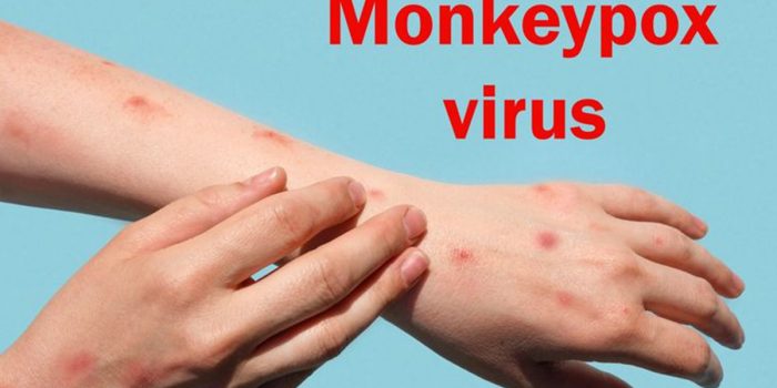 Dinkes Pastikan Tak Ada Kasus Cacar Monyet di Kabupaten Serang